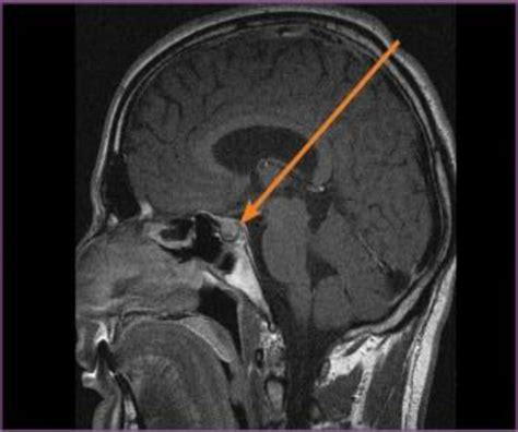 Second Mri T1 Weighted Sagittal The Pituitary Fossa Shows A