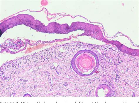 Figure 1 From A Neonate With Aplasia Cutis Congenita Type Vi With