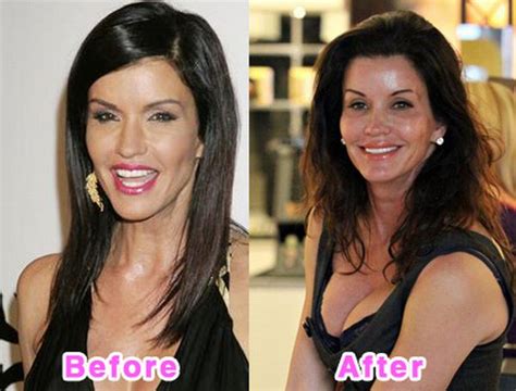 Celebrity Plastic Surgery Disasters Before And After 16 Pics