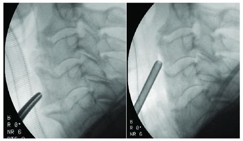 Intraoperative Fluoroscopic Imaging Before And After Osteophyte Removal