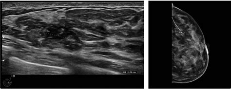 Ductal Carcinoma In Situ Symptoms Causes Treatment 41 Off