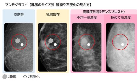 乳がんの検査~マンモグラフィ・超音波・mri~ Medock 総合健診クリニック