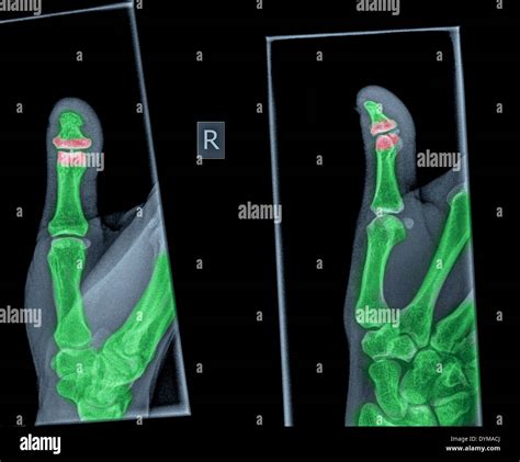 X-ray of a thumb with a broken distal phalanx Stock Photo - Alamy