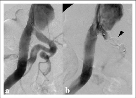 Occlusion Of The Iia Using A Vascular Plug A Angiography Of The Iliac