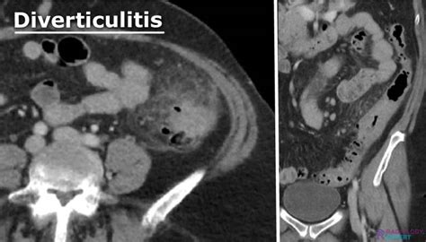 CT abdomen general