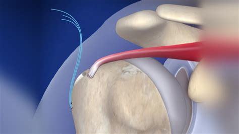 Supraspinatus Tendon Tear Treatment