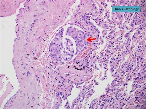 Qiao S Pathology Lymphangitic Carcinomatosis Of The Lung A Photo On Flickriver