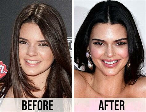 Kendall Jenner Nose Job: What Happened and the Latest Update ...