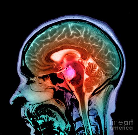 Brain Cyst Photograph by Simon Fraser/science Photo Library - Fine Art ...