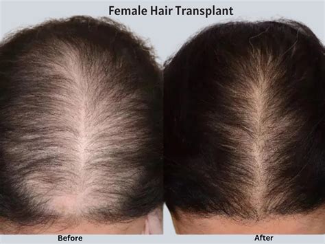 Hair Transplant In Bergen County Restore Natural Hairline