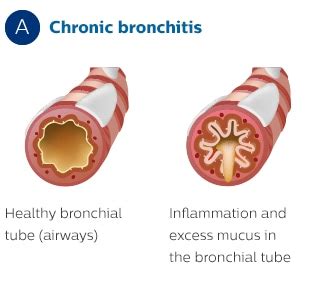 Philips COPD therapy and treatment solutions | Philips