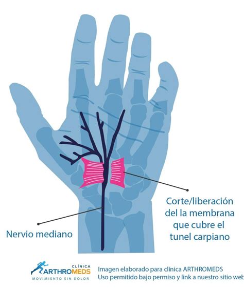 Cirug A Del Tunel Carpiano De La Mano Lima Per