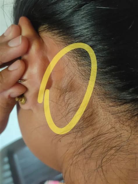 Lump Behind Both Ear