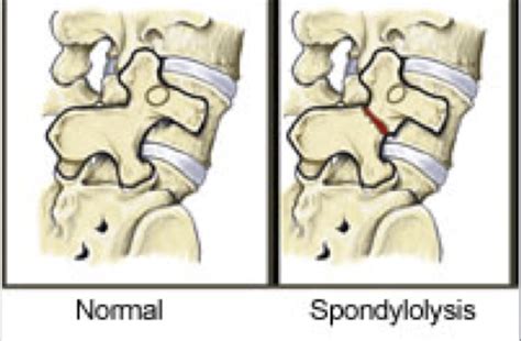 Lumbar Pathology Flashcards | Quizlet