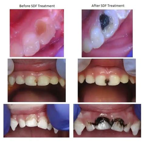 Silver Diamine Fluoride (SDF) Information - Lollipop Dental Pediatric ...