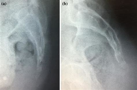 Lateral Coccyx Xray