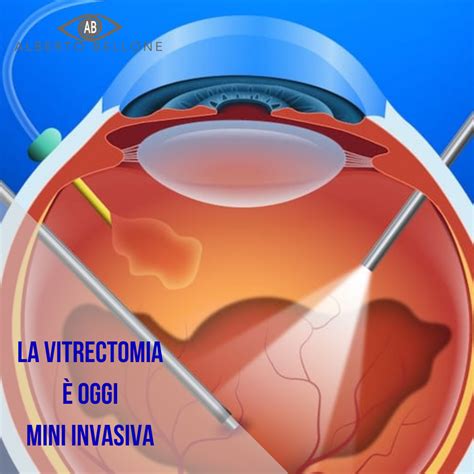 La vitrectomia è oggi mini invasiva vitrectomia corpovitreo retina