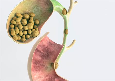 gallbladder disease  gallstones functional medicine