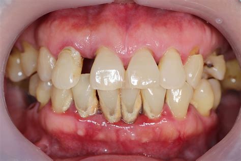 Periodontitis Kabeh Sampeyan Pengin Ngerti Apollo Health Library Blog