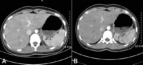 A Arterial Phase Axial Computed Tomography Ct Scan Shows An