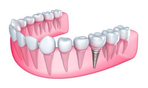 Do Dental Implants Hurt The Surrounding Gums Dental General