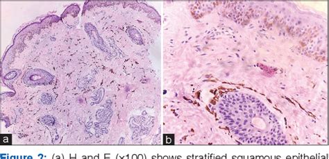 Figure 1 From Bilateral Nevus Of Ota A Case Series And Literature