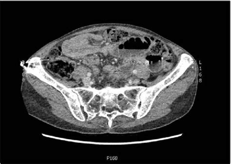 Axial Slice Of Ct Abdomen And Pelvis Showing An Intussusception