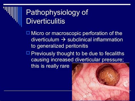 Diverticular Disease Of Colon