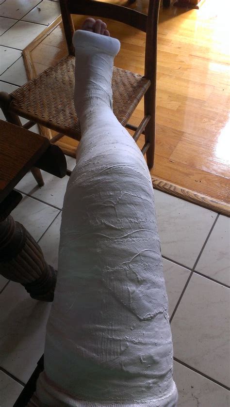 First Plaster Long Leg Cast 4x4king10 Flickr