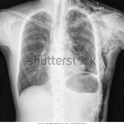 Chest X Ray Dataset 5 Types Kaggle