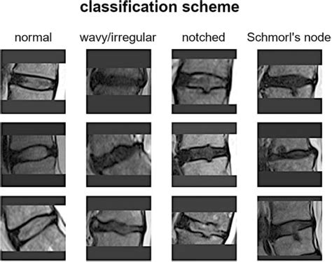 Frontiers Automatic Classification Of The Vertebral Endplate Lesions