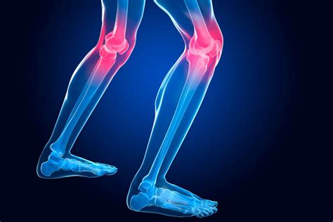 Tendinitis De La Pata De Ganso Síntomas Causas Tratamiento Y