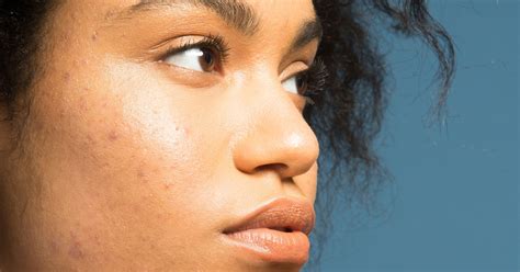 Black Skin Care Dermatologist Red Flags Need To Know