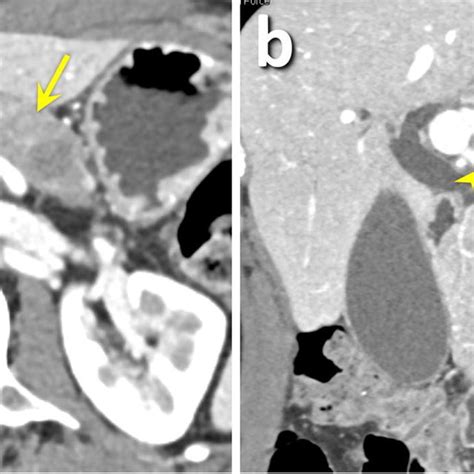 A 62 Year Old Female With Pancreatic Ductal Adenocarcinoma Pdac