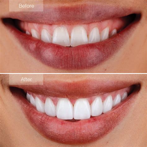 Porcelain Veneers Before And After The Dental Room