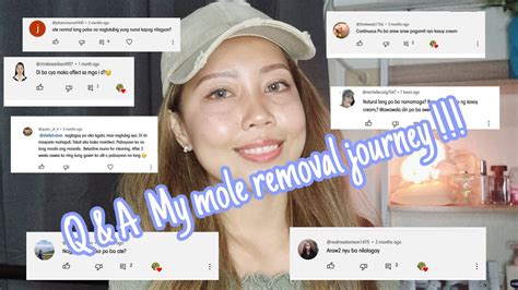 Q A My Journey Of Getting My Mole Removed Moleremove Kasoy