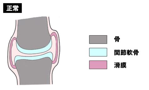 関節リウマチについて正しいのはどれか【第53回理学療法士国家試験am87】 — 理学療法士国家試験対策ptes