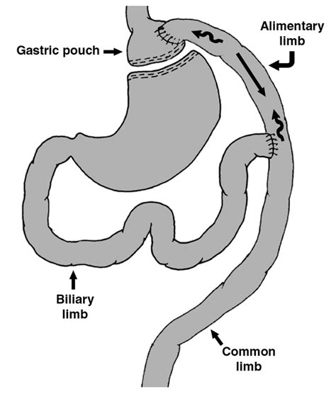 Roux En Y Gastric Bypass Afferent Limb