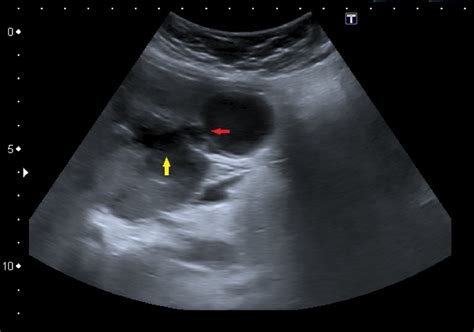 Perforated Gallbladder Ultrasound