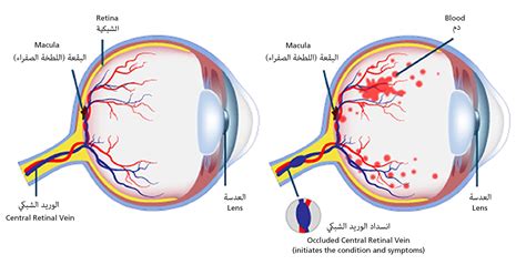 retinal vein occlusion  moorfields eye hospital dubai eye