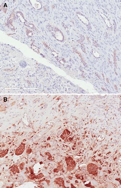 A Photomicrograph Of Odontogenic Epithelium In Cellular Fibroblastic