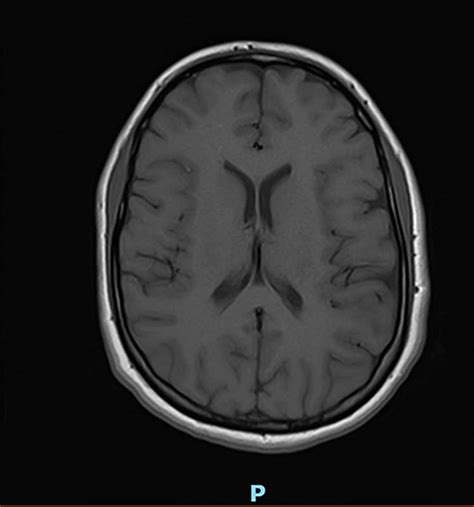 MRI brain on admission -T2. MRI, magnetic resonance imaging. Fig. 2 ...