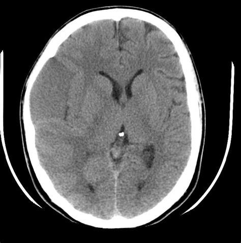 Posterior Fossa Arachnoid Cyst Mri