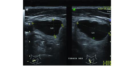 Labeled Thyroid Ultrasound