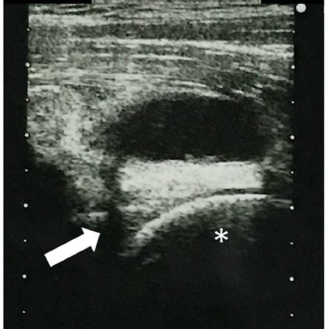 Preoperative Ultrasonography Image Shows The Hypoechoic Mass Anterior