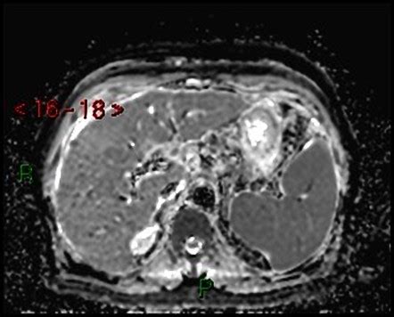 Multifocal Hepatocellular Carcinoma Image Radiopaedia Org