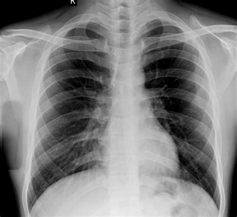 Chest X-ray Fracture Right Posterior 6th Rib And Possible, 53% OFF