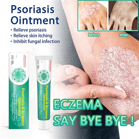 Jemeesen Eczema Cream Psoriasis Ointment Chinese Herbal Antifungal