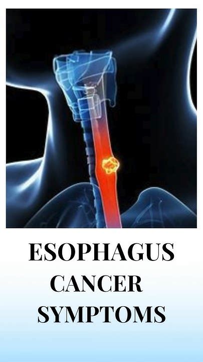 Esophagus Cancer Symptoms 7428617074 Youtube