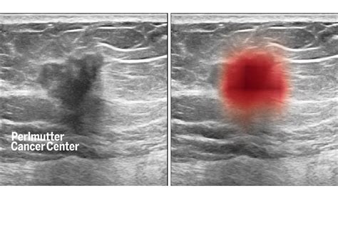 What Does Breast Cancer Look Like On An Ultrasound